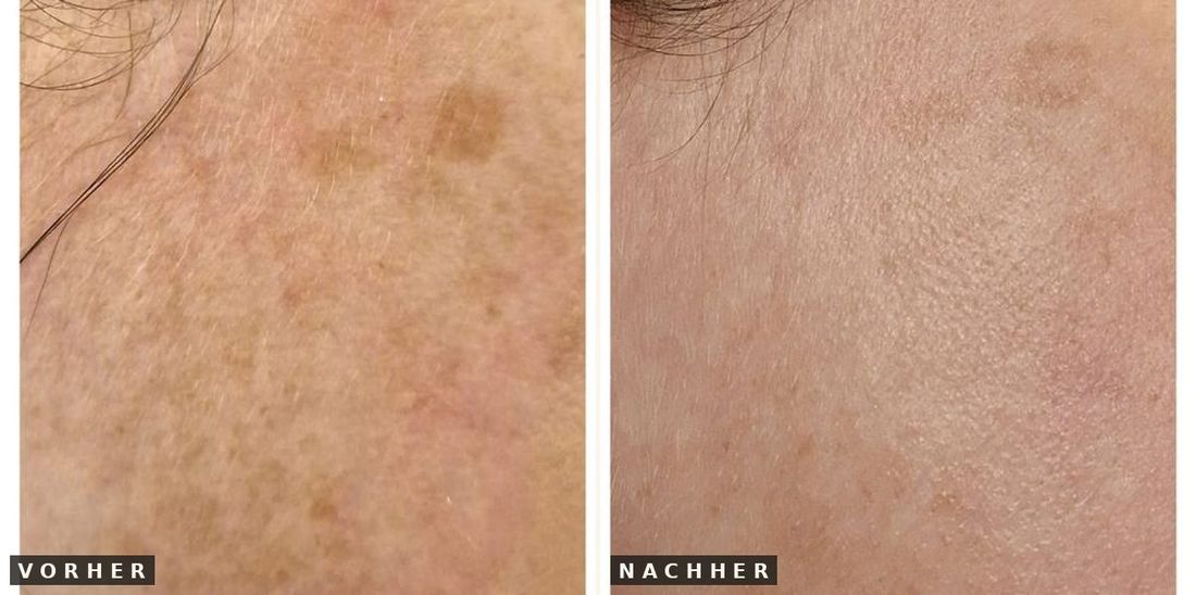 Pigmentflecken vorher nachher
