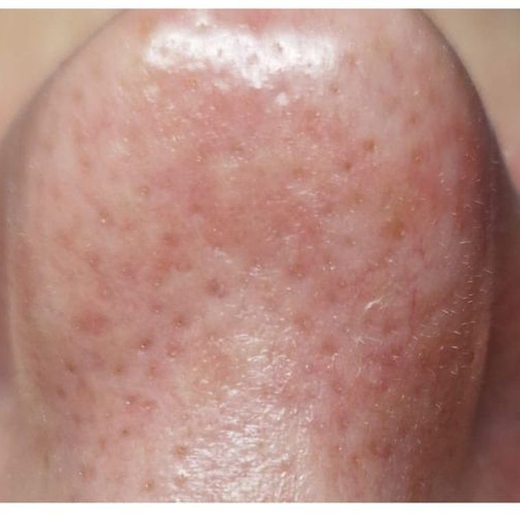 Fruchtsäurepeeling Ergebnis