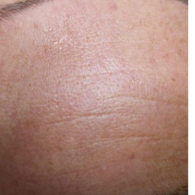 Microneedling Ergebnis